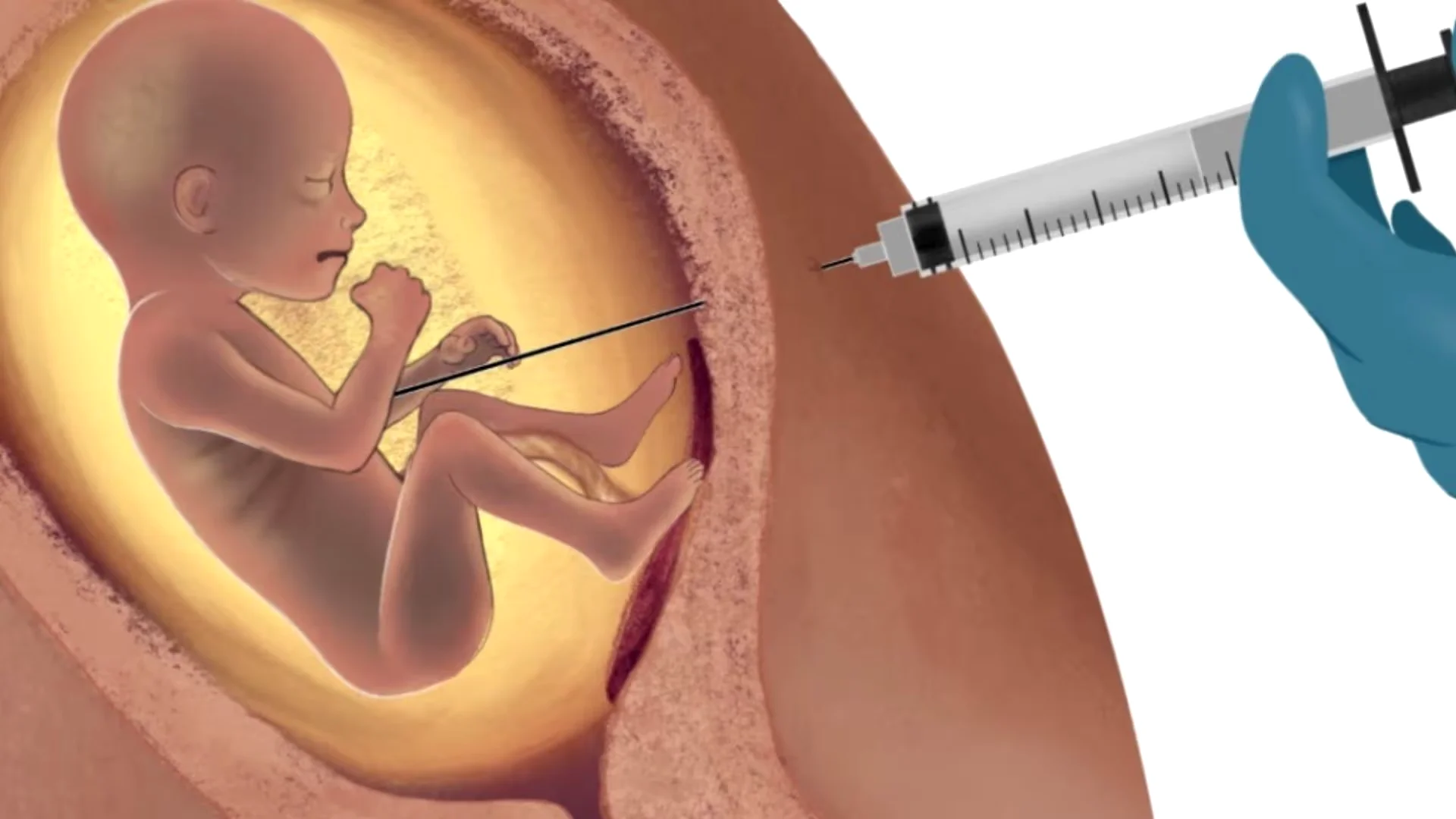 Assistolia Fetal